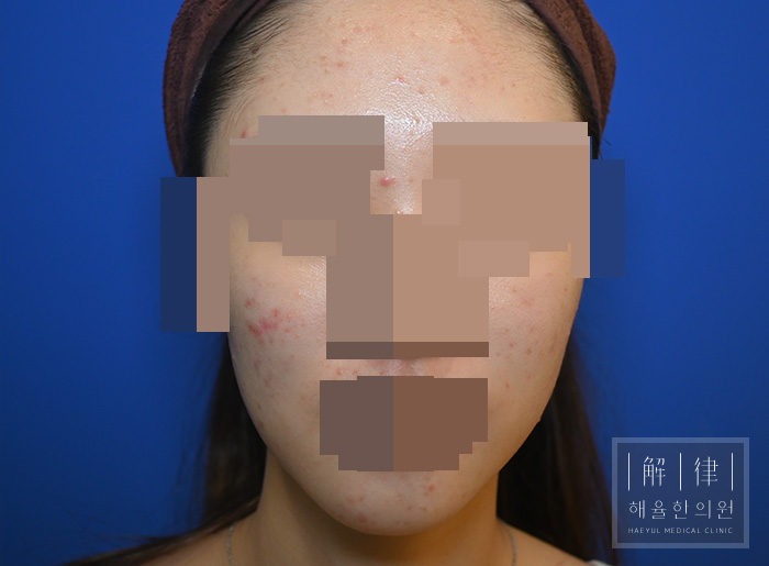 [목동점] 얼굴화농성여드름 치료 전 사진 - 해율한의원